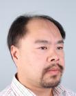 Before Hair Transplant&nbsp;Front